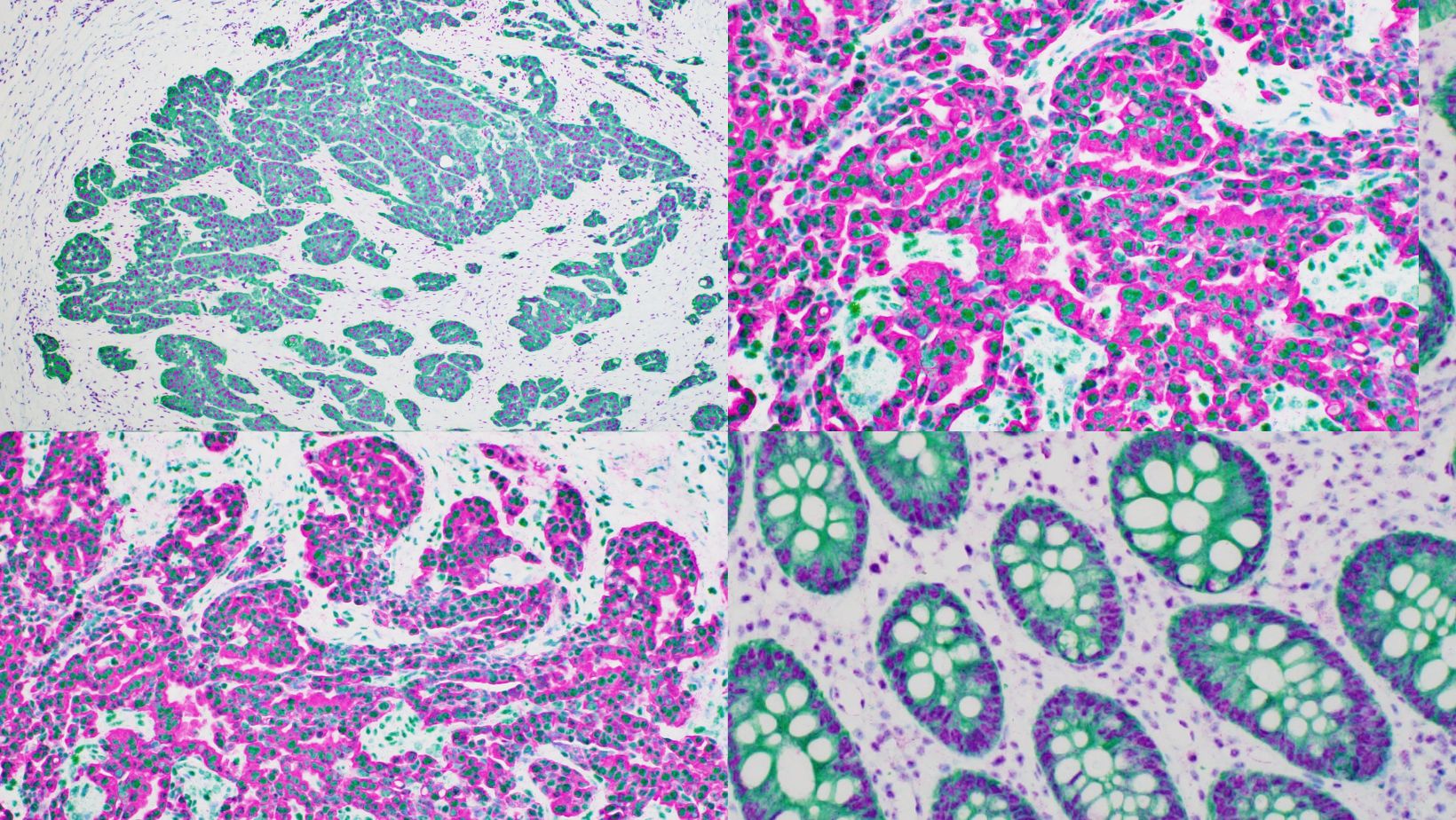 Four colorful slides highlighting multiple markers using new chromagen stains